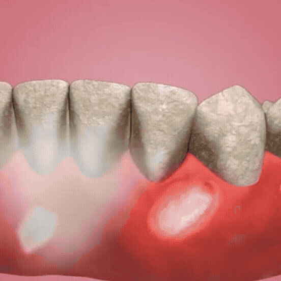 Espuma Blanqueadora Dental VOQUE