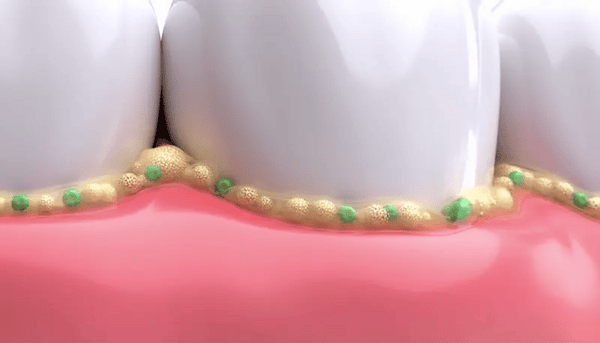 Dentite Tooth Armor: iAdiós al dolor, hola dientes fuertes!