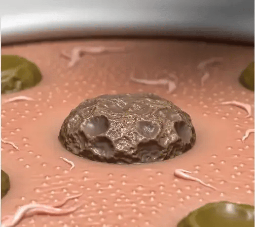 Crema Veneno de Abejas Para Verrugas