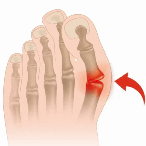 Aliviador de Juanetes